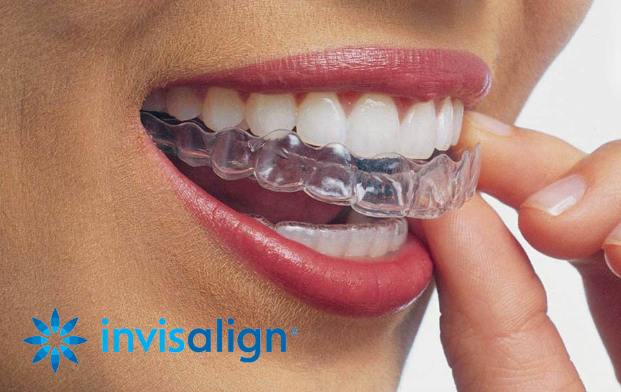 invisalign, invisible teeth aligners, D. Scott Trettenero DDS, Scott Trettenero DDS, Fort Myers Dental Office, Fort Myers Dental Work, Fort Myers Dental Care, Fort Myers Dentists, Fort Myers Dentistry, General Dentistry, Dental Office near me, dentists near me, Fort Myers Dentist, Fort Myers Dentist office, Fort Myers Dental clinics, Fort Myers Dentist offices